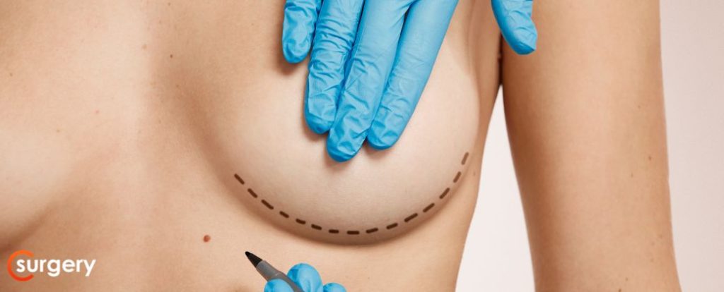 ניתן לראות פלג גוף עליון של אישה אשר כנראה עומדת לעבור ניתוח מסטקטומי
 ומסמנים את השד שלה בעזרת עט סימון רפואי ובצד שמאל למטה לוגו אתר surgery